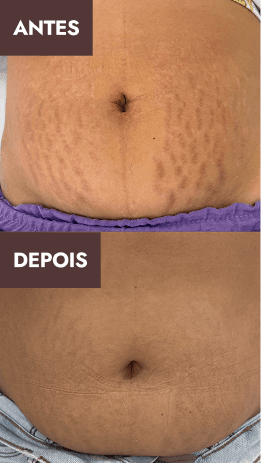 Antes e depois 1