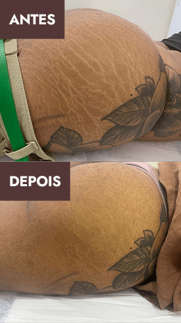 Antes e depois 2
