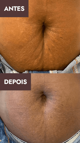 Antes e depois 5