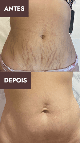 Antes e depois 7